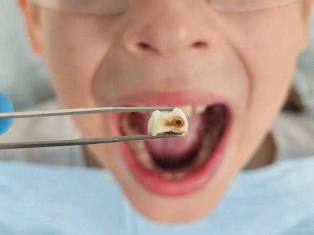 Best Emergency Treatment for Dental Infections or Abscesses in Pinconning, MI